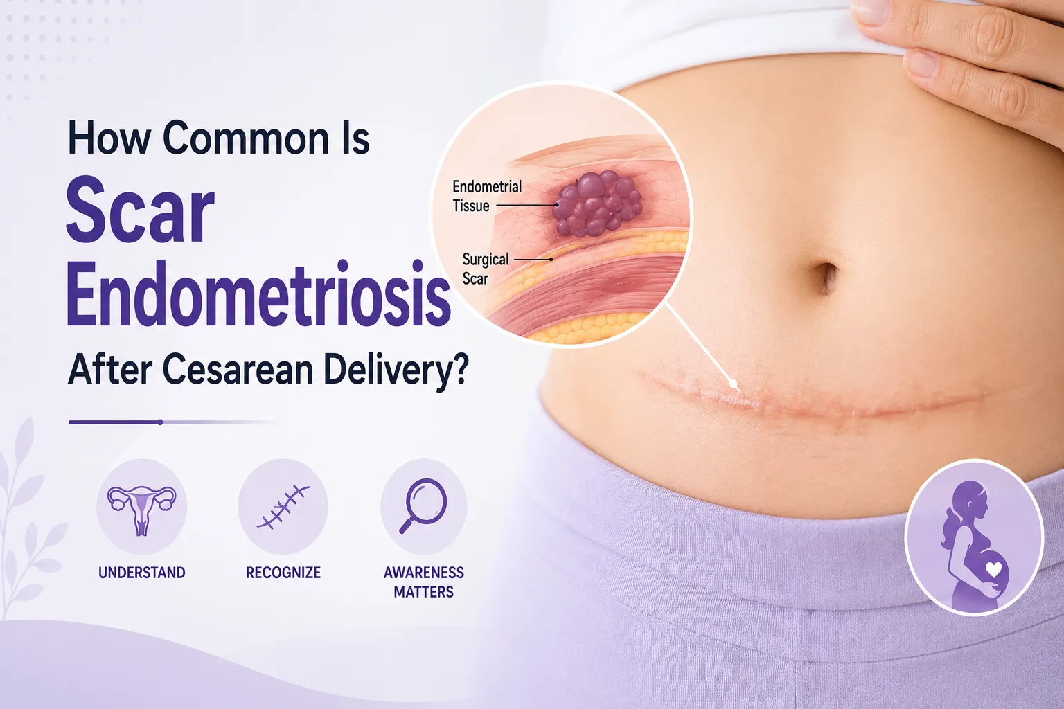 How Common Is Scar Endometriosis After Cesarean Delivery